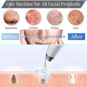 Vacuum Blackhead Remover