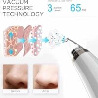 Vacuum Blackhead Remover